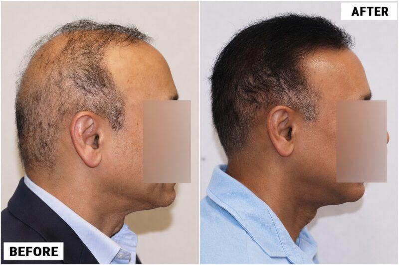 FUE 3241 grafts - before & after 2nd procedure right 2