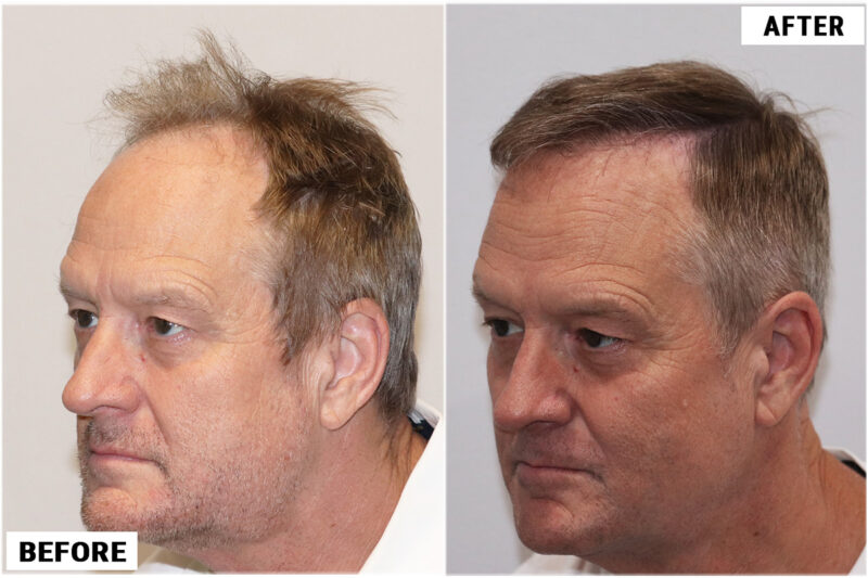 Before & after 1989 grafts FUE left