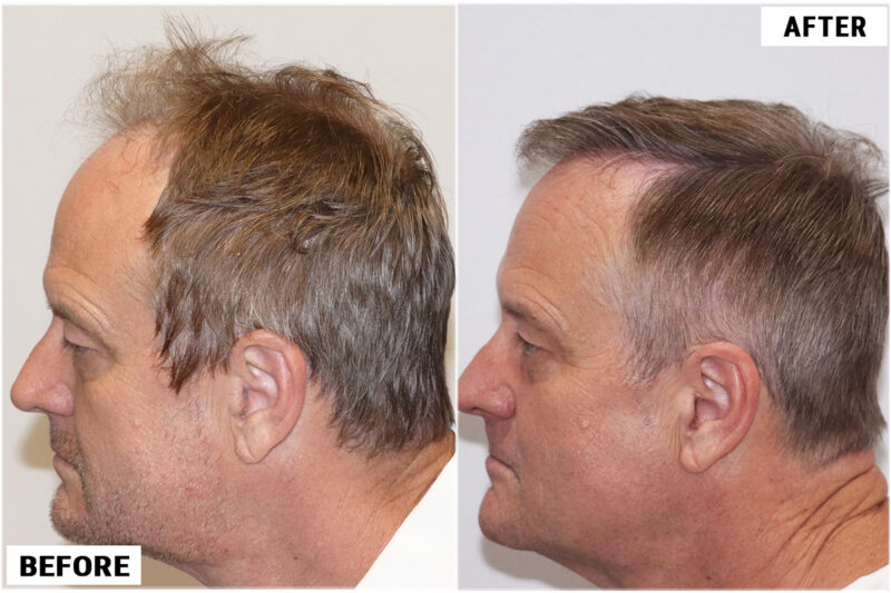 Before & after 1989 grafts FUE left #2