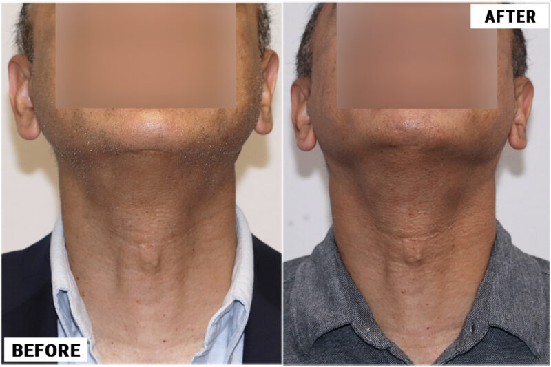Body hair before and after extractions from Jaw line and beard