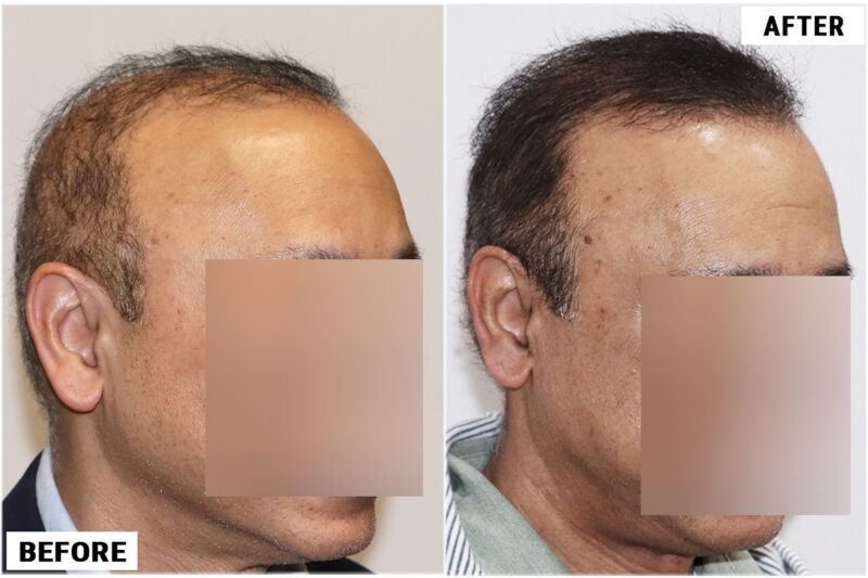 FUE 3241 grafts - before & after left