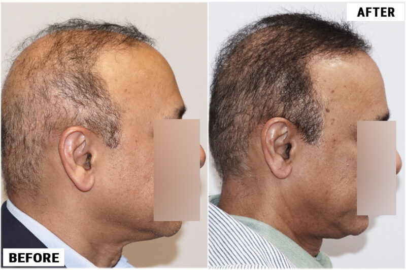 FUE 3241 grafts - before & after left #2