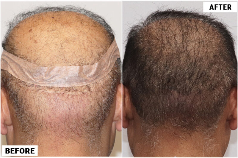 FUE 3241 grafts - before & after scar