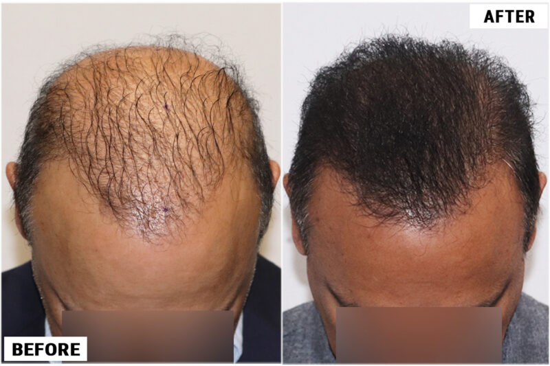 FUE 3241 grafts - before & after 2nd procedure top