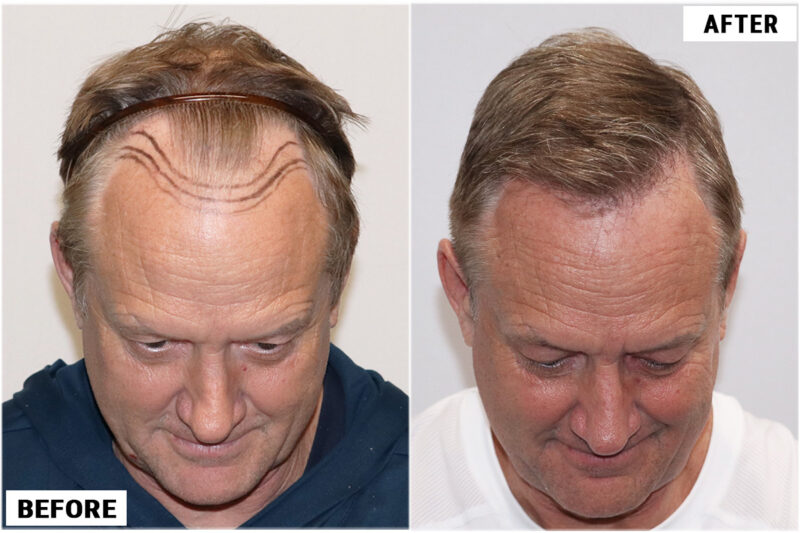 Before & after 1989 grafts FUE top #2