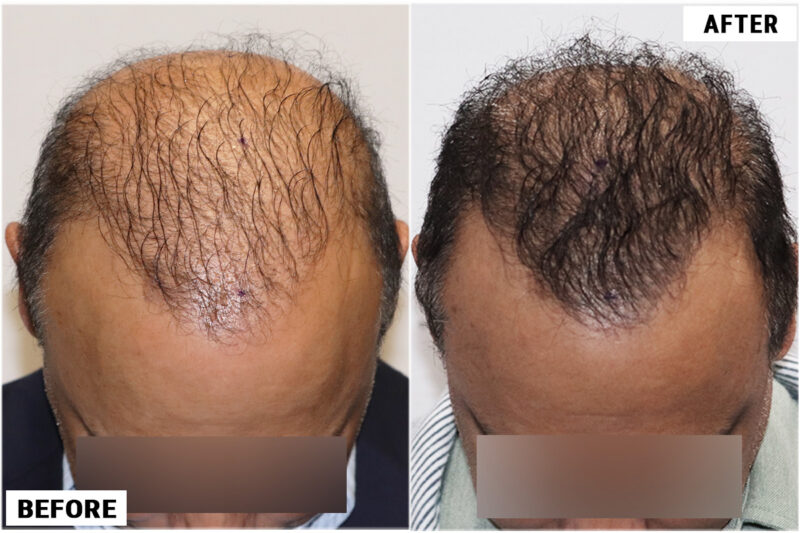 FUE 3241 grafts - before & after top wet