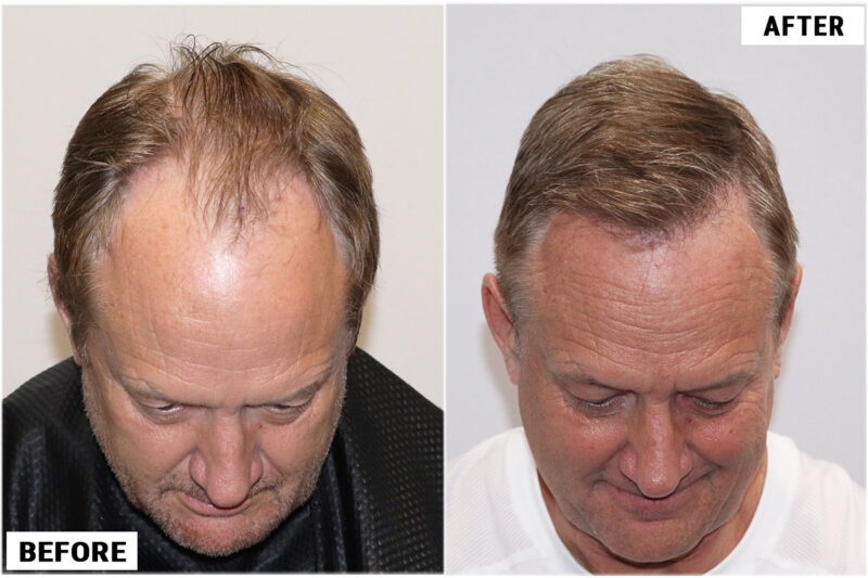 Before & after 1989 grafts FUE top #3