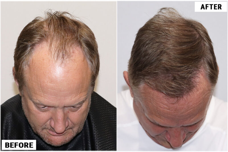 Before & after 1989 grafts FUE top