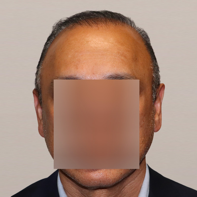 FUE 3241 grafts - before & after front dry