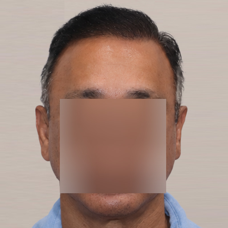 FUE 3241 grafts - before & after front dry