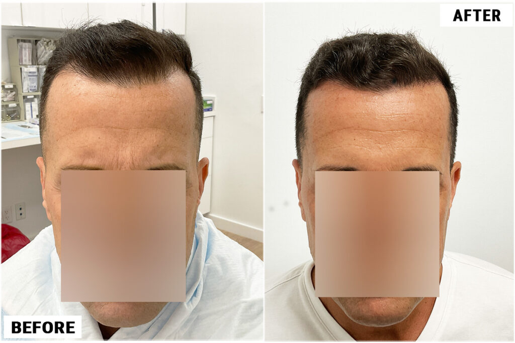 806 grafts FUE before & after front