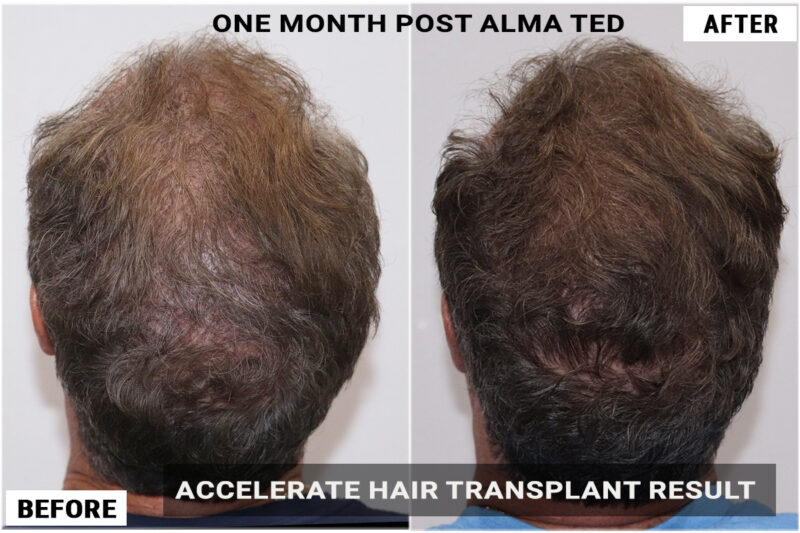 1 month post almated results crown