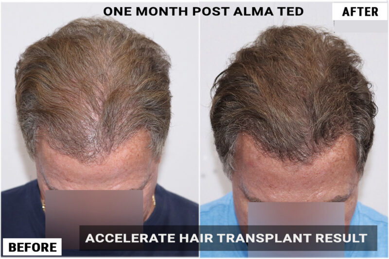 1 month post almated results top