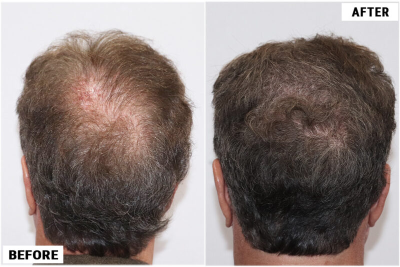before & after 1950 grafts back
