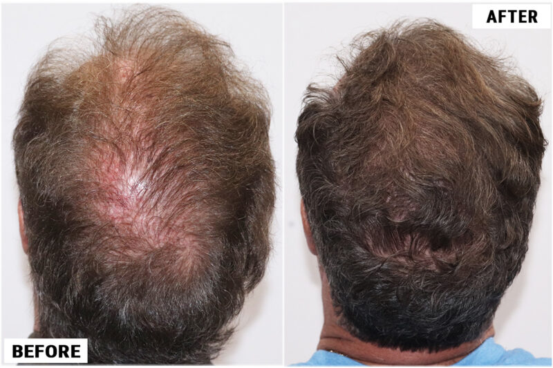 before & after 1950 grafts crown