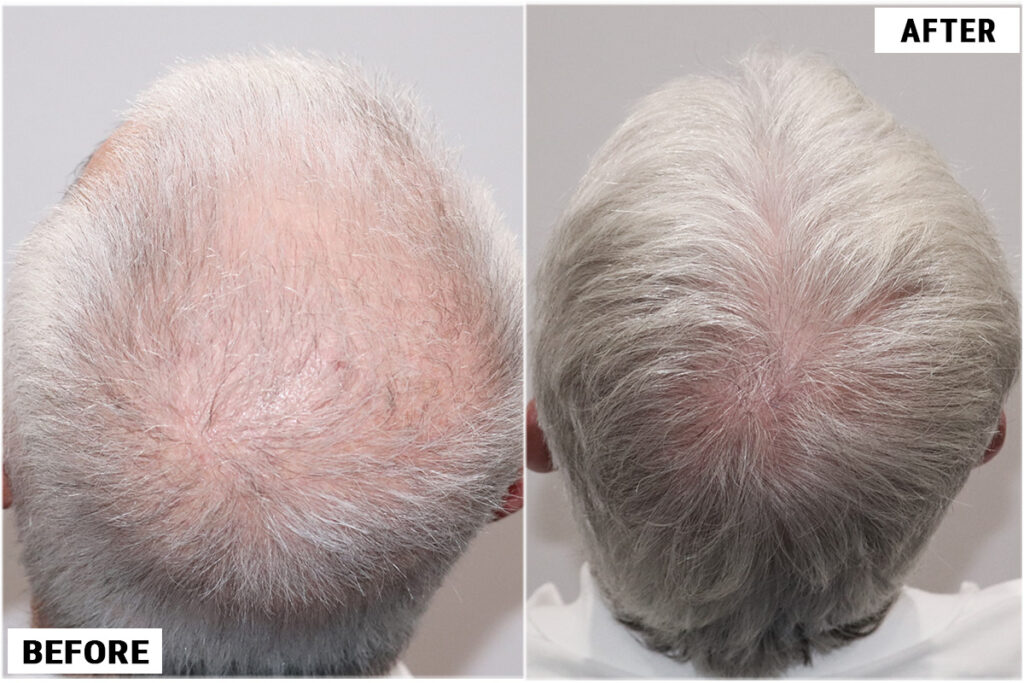 PRP 6 before & after crown