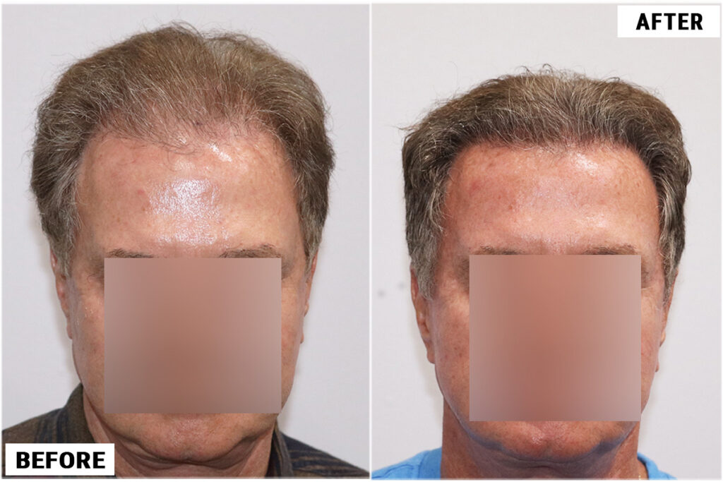 before & after 1950 grafts front