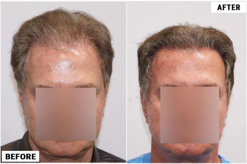 before & after 1950 grafts front