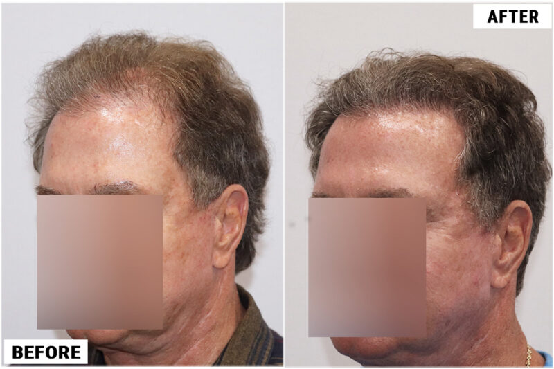 before & after 1950 grafts left