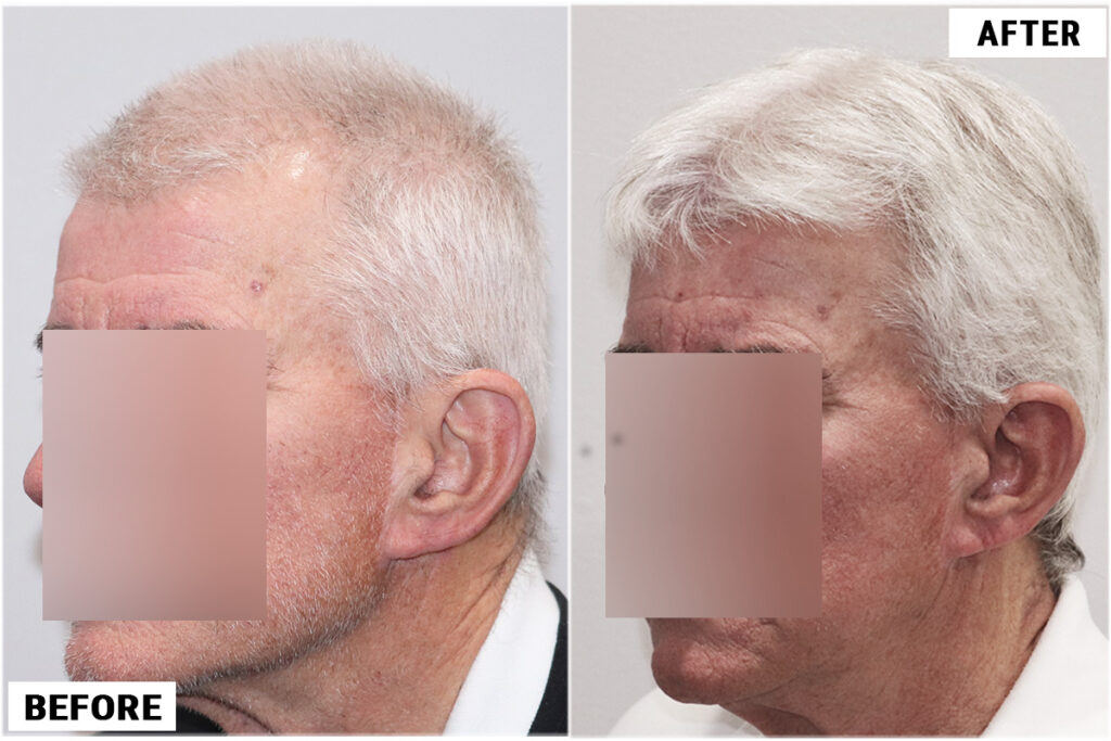 PRP 6 before & after left