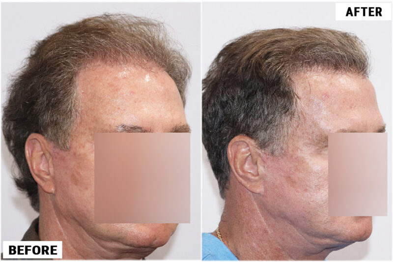 before & after 1950 grafts right
