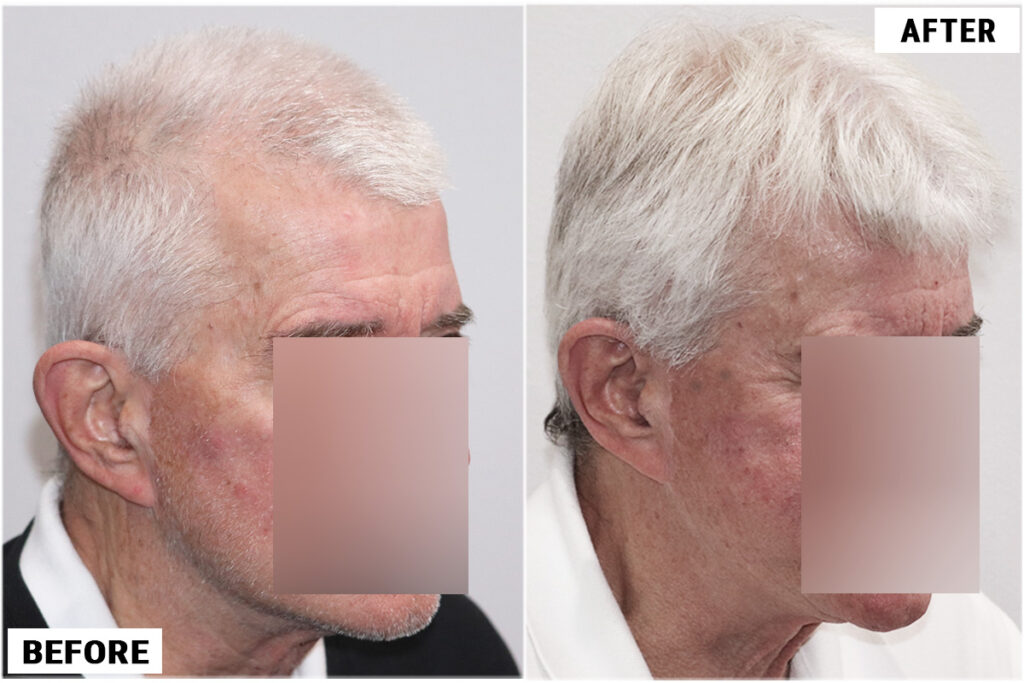 PRP 6 before & after right