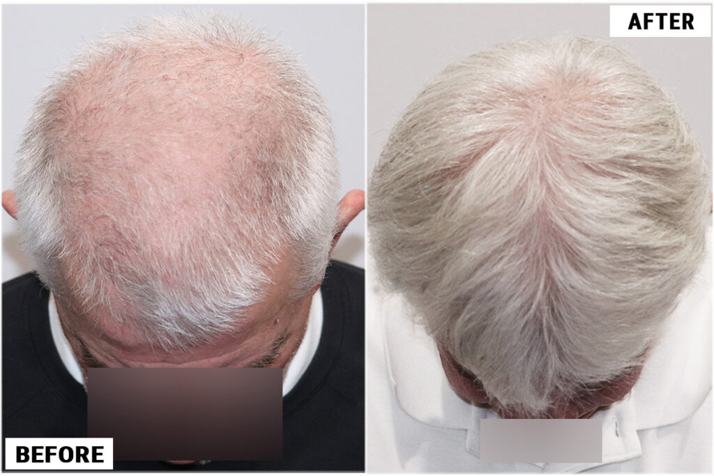 PRP 6 before & after top