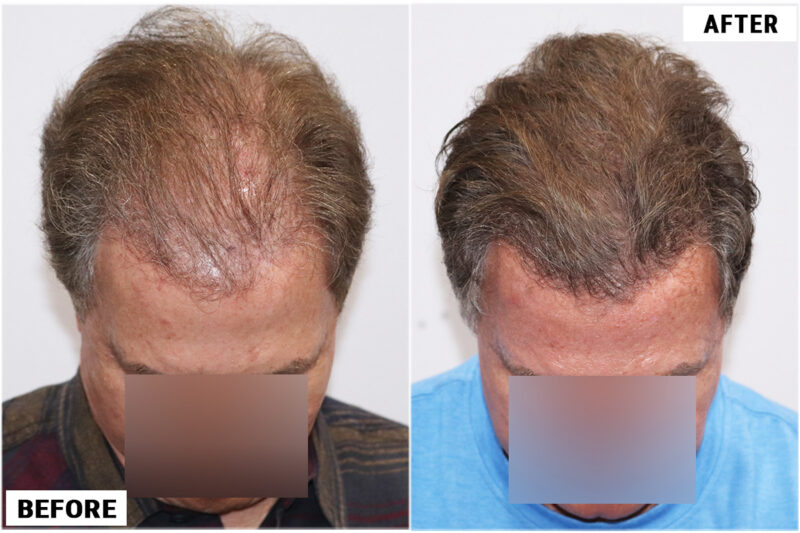 before & after 1950 grafts top