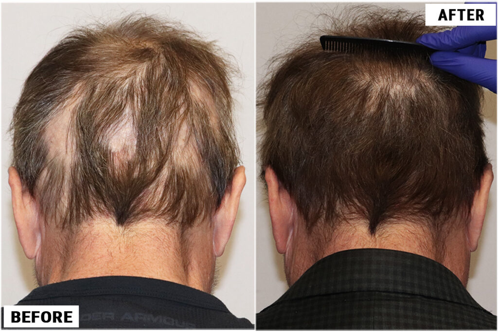 Stem Cell #2 before & after donor area