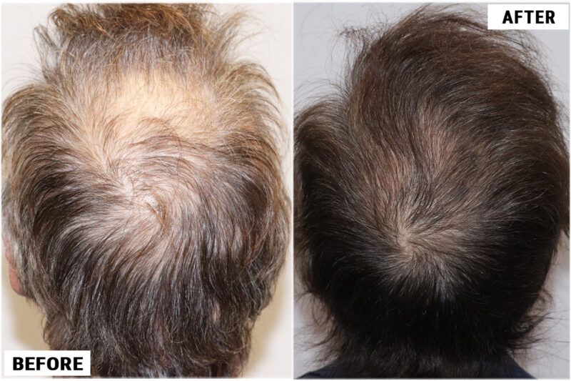 Stem Cell #2 before & after crown view