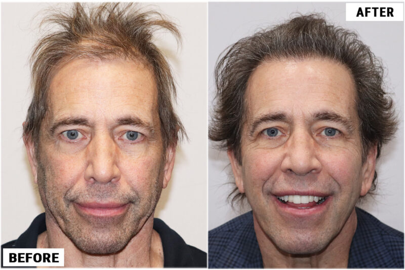 Stem Cell #2 before & after front 2