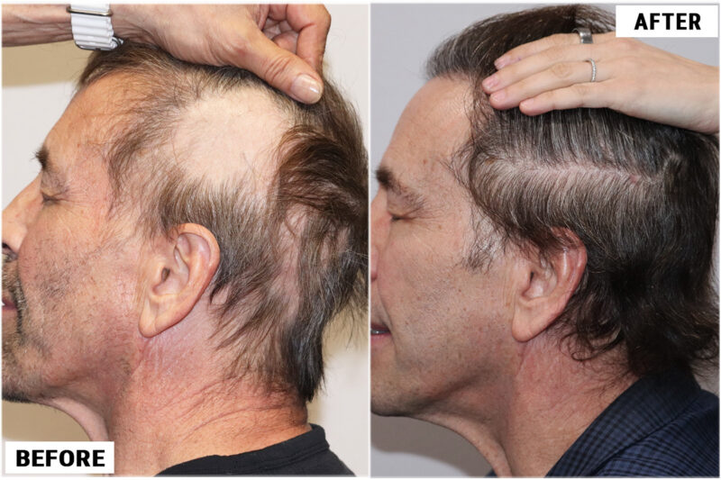 Stem Cell #2 before & after left side