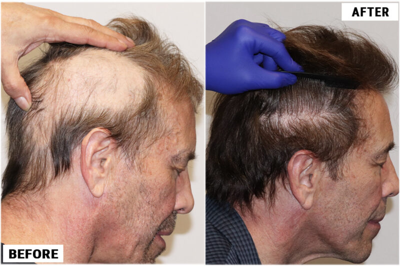 Stem Cell #2 before & after right side