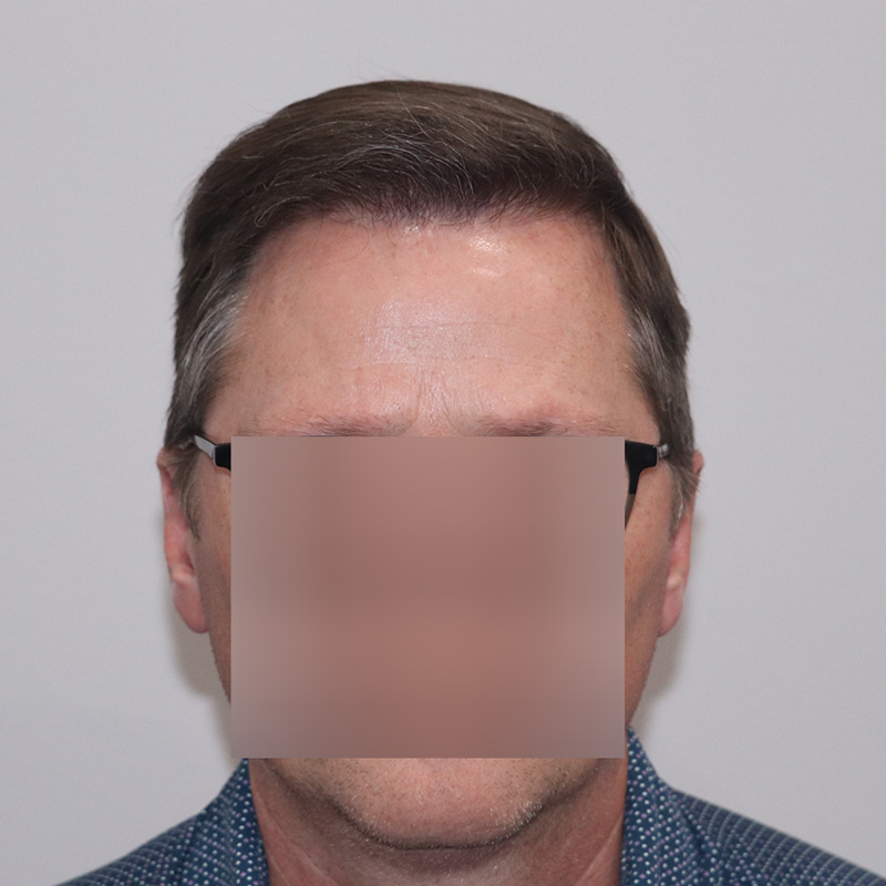 FUE 3067 grafts before and after front