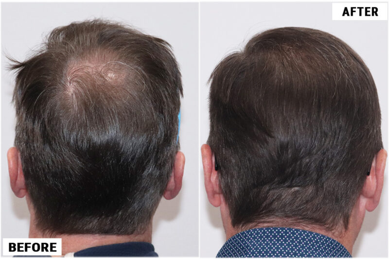 FUE 3067 grafts before and after back (donor area)