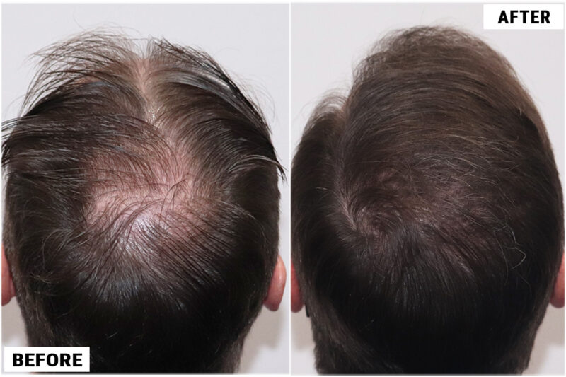FUE 3067 grafts before and crown view