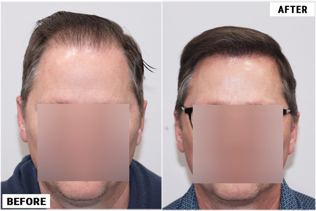 FUE 3067 grafts before and after front