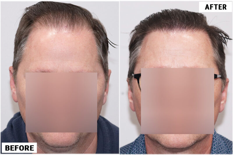FUE 3067 grafts before and after front wet hair
