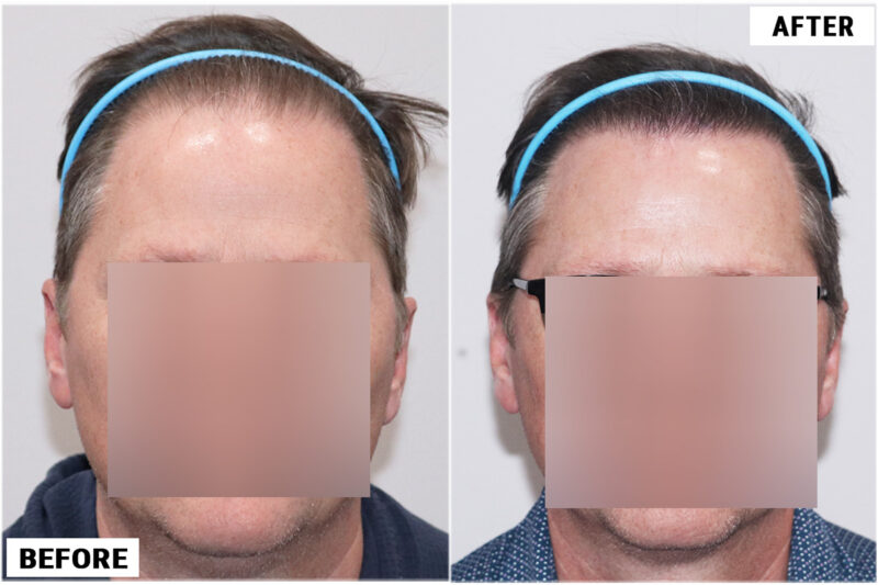 FUE 3067 grafts before and after front wet pulled back