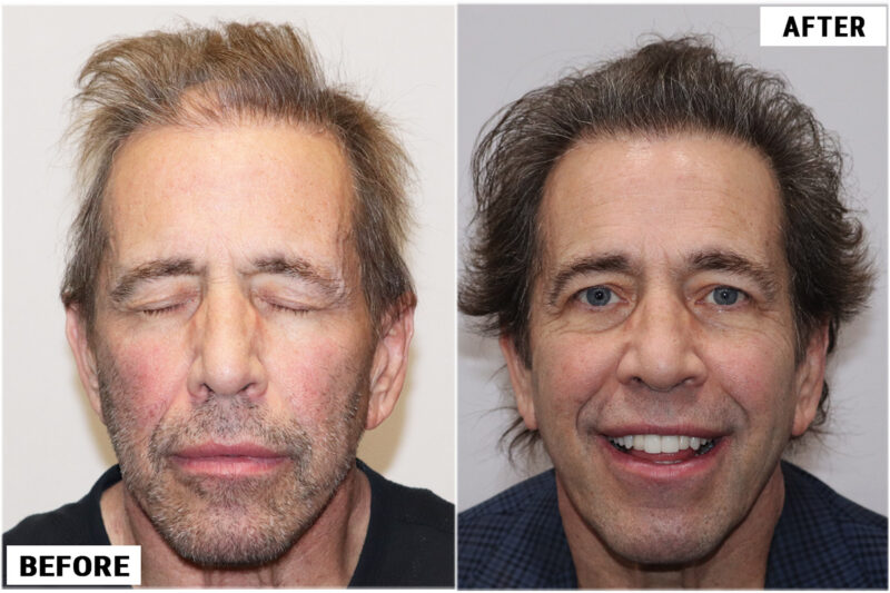 Stem Cell #2 before & after front 3