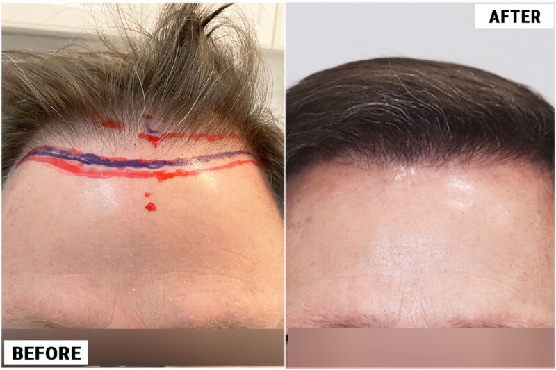 FUE 3067 grafts before and after front - lowered hairline