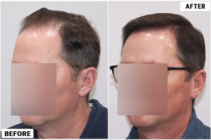 FUE 3067 grafts before and after front left