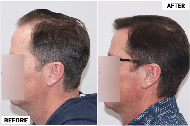 FUE 3067 grafts before and after front left 2