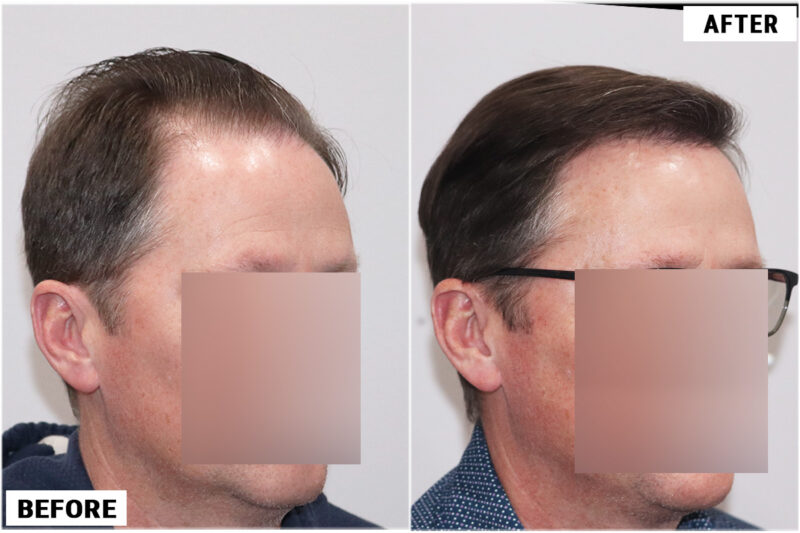 FUE 3067 grafts before and after front right