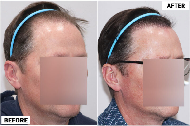 FUE 3067 grafts before and after right wet hair