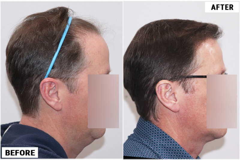 FUE 3067 grafts before and after front right side 2