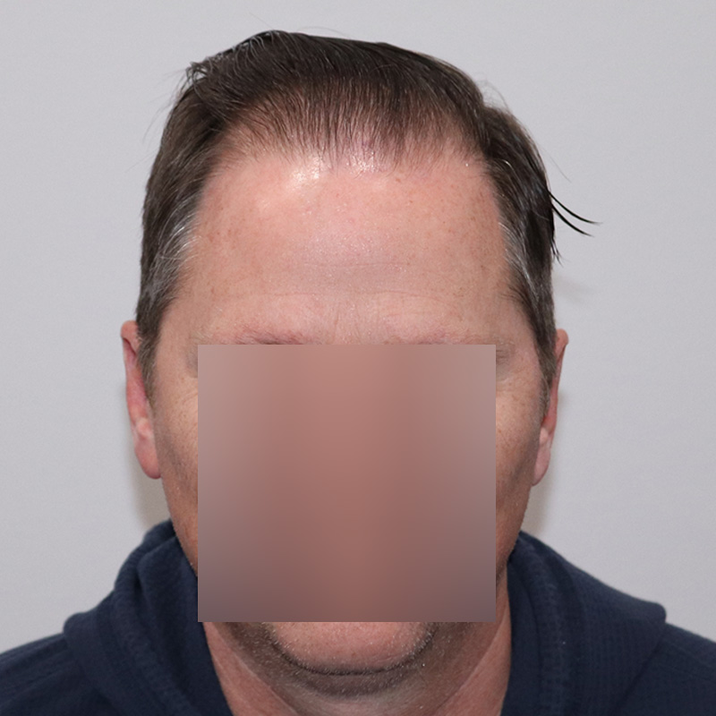 FUE 3067 grafts before and after front