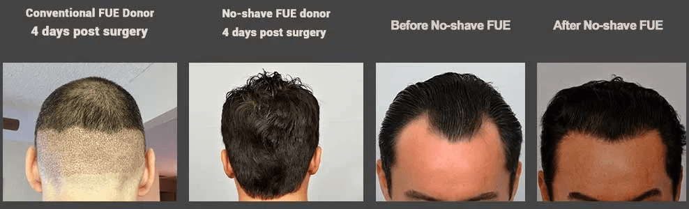 recovery after surgery