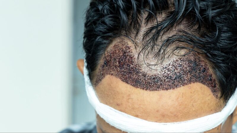A male patient after the no-shave FUE (C2G) procedure, showing the top of the forehead with newly implanted hair follicles and scabbing.
