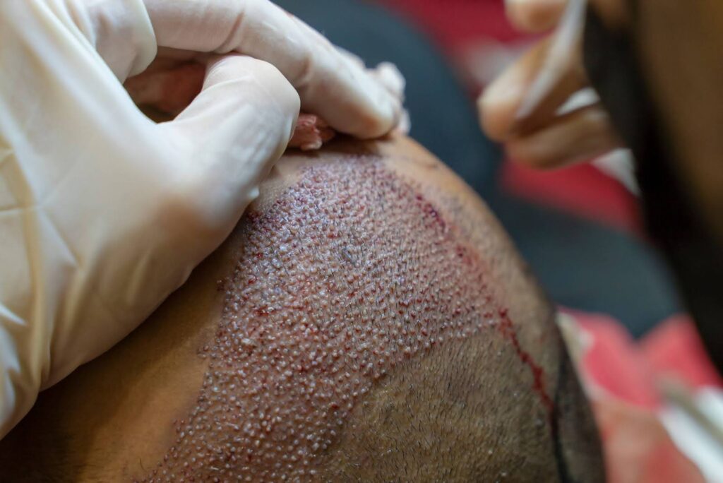 Hair transplant procedure performed by a physician in white gloves.